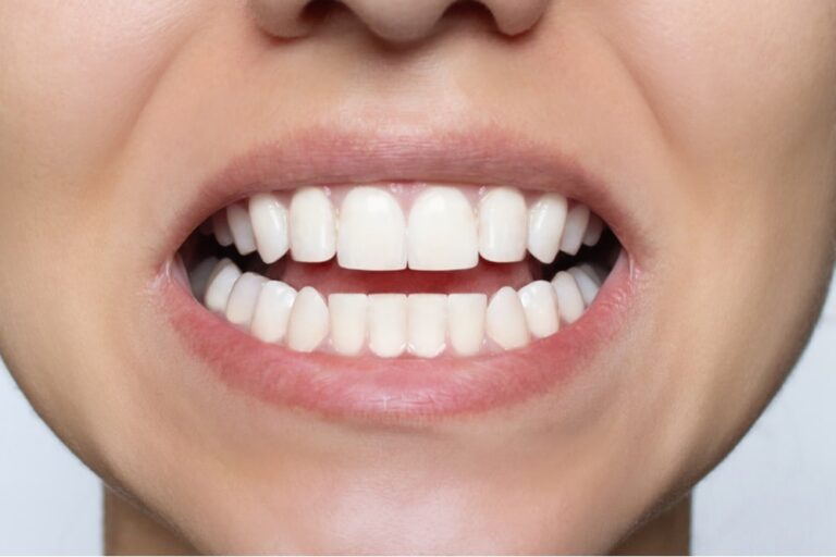 After Dental treatment