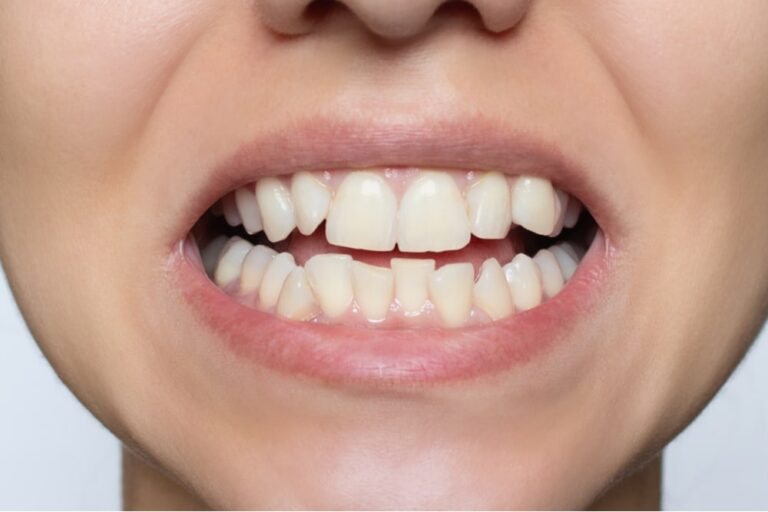 Before Dental treatment