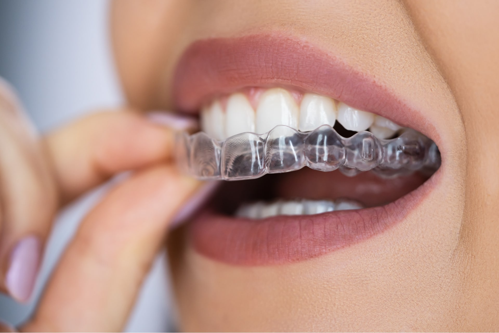Clear Aligner Dental
